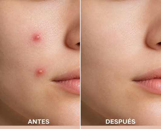 Parches Anti-Acné Hidrocoloide — Elimina espinillas sin dejar marcas